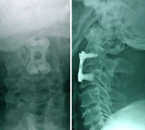 CERVICAL FRACTURE FIXATION – HIGH CERVICAL ANTERIOR APPROACHES ARE NOW POSSIBLE